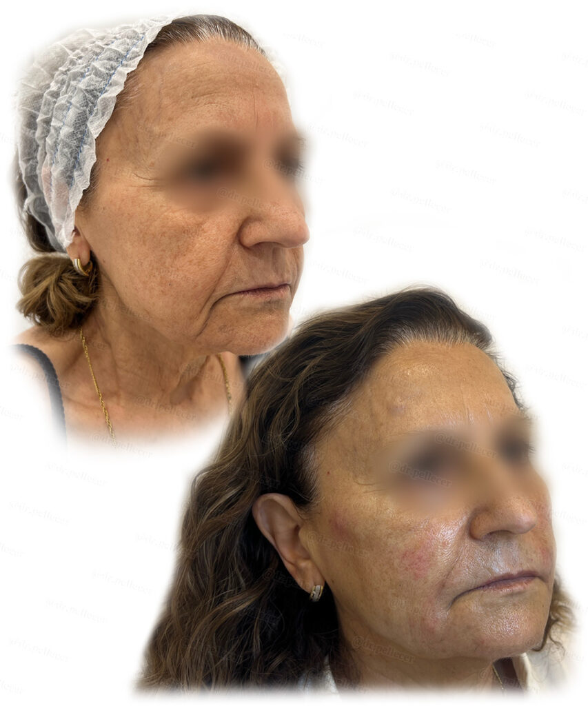 La imagen tiene un atributo ALT vacío; su nombre de archivo es face_botox_filler_port_half_1-853x1024.jpg